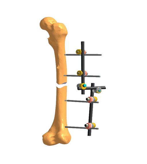Femur fixator