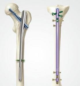 Bloklovchi intramedulyar osteosintez