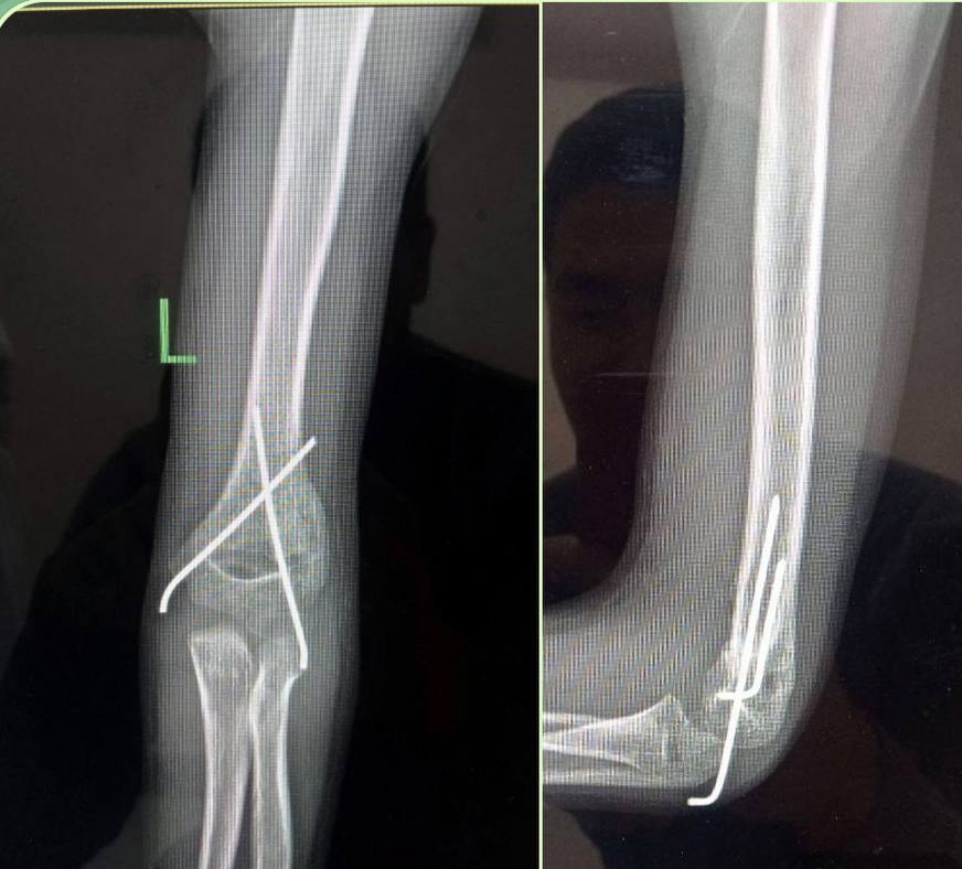 Teri kesmalarisiz osteosintez