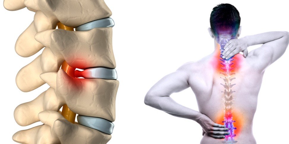 Umurtqa churrasini konservativ davolash