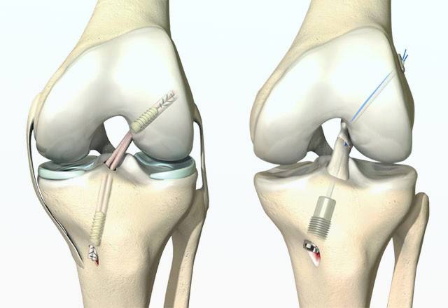 Sport travmalarini davolash