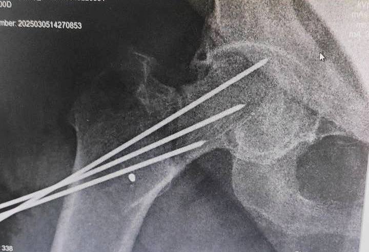 Mini invaziv osteositez