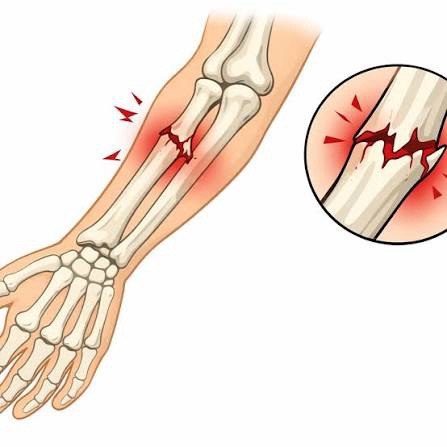 Suyak sinishlarini davolash